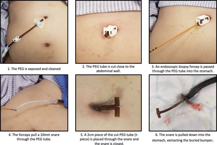 Cpt for peg tube removal